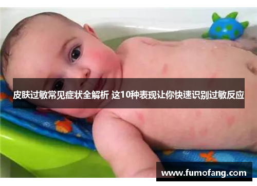 皮肤过敏常见症状全解析 这10种表现让你快速识别过敏反应 皮肤过敏常见症状全解析 这10种表现让你快速识别过敏反应